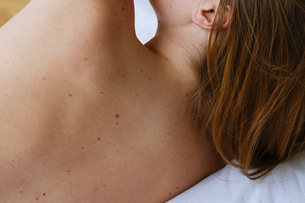 Removing Skin Lumps and Bumps | Visit our Skin Cancer Clinic – Skin Cancer Treatments by a GP